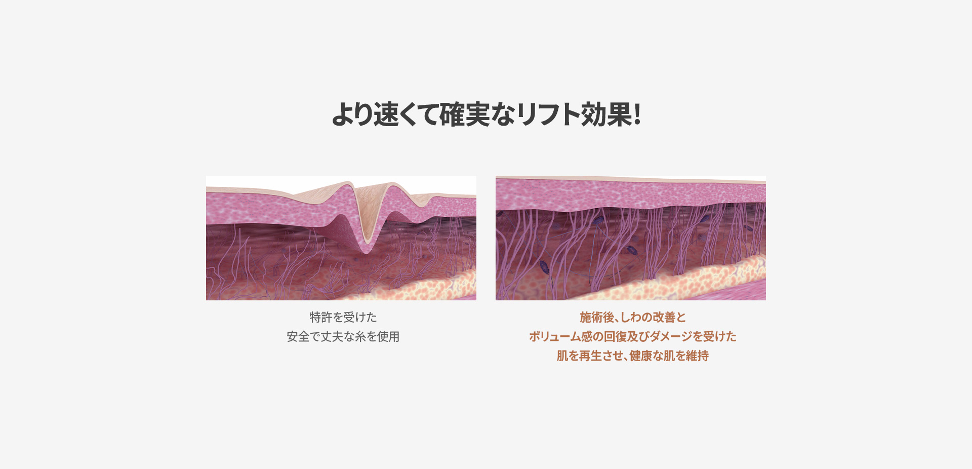 糸リフト5